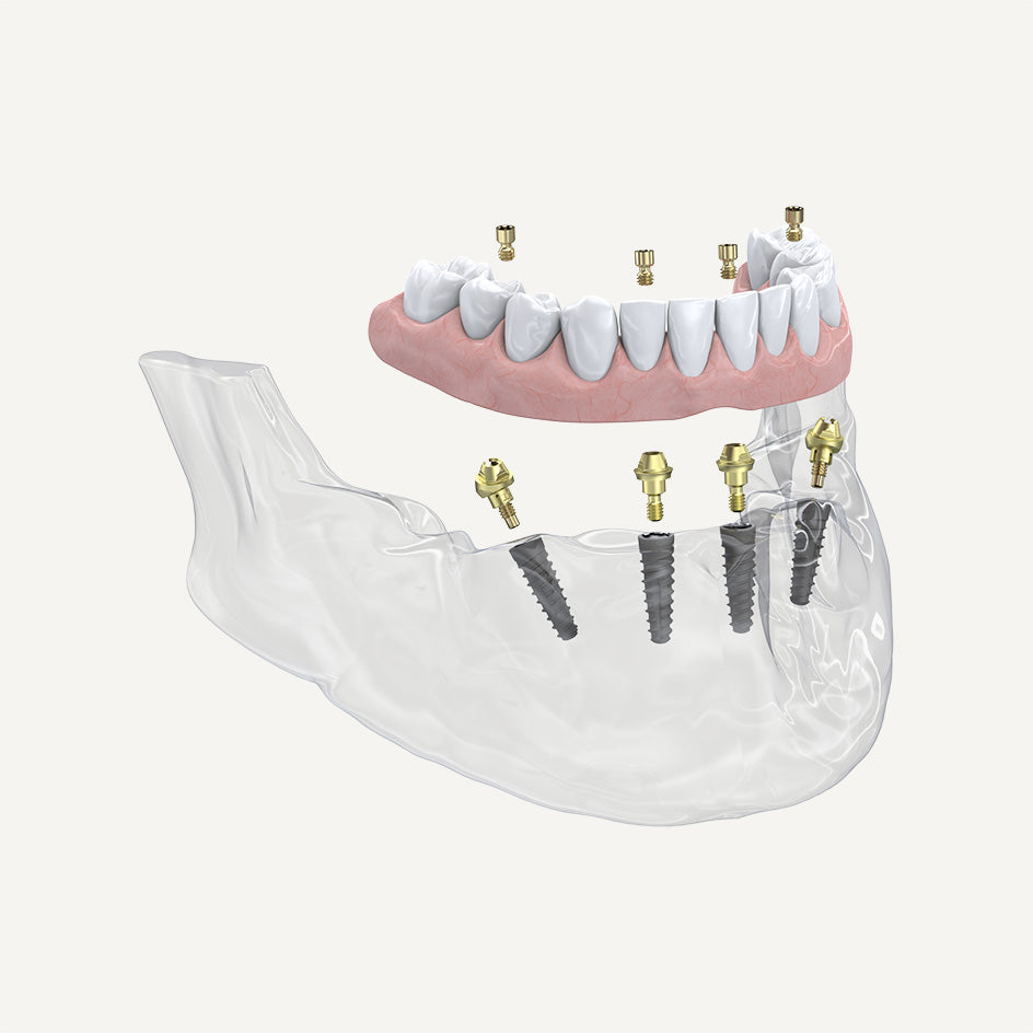 Multi-Unit Abutment